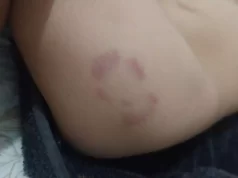 Mãe de aluno pede transferência do filho para outra creche, após criança aparecer com machucados e mordidas em São José dos Campos